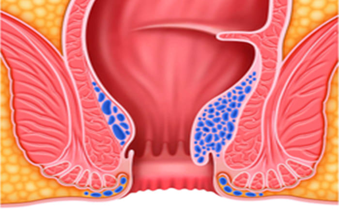 ब्लीडिंग रोकें